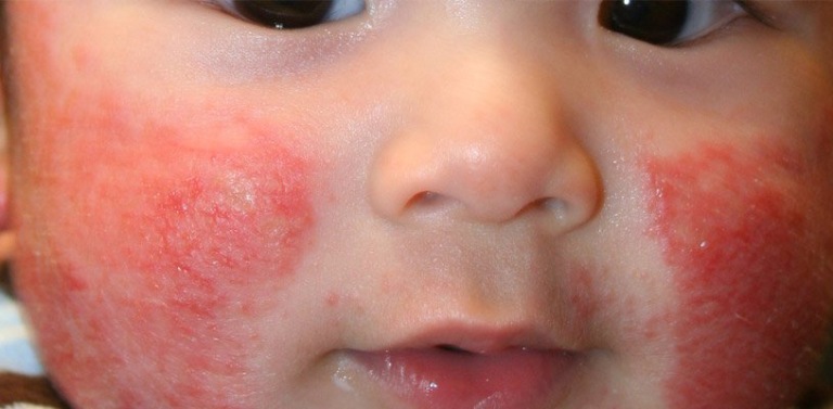 Bệnh đặc trưng bởi sự xuất hiện của các mụn nước li ti trên nền da ửng đỏ
