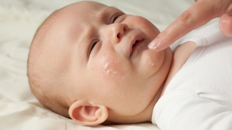 Trẻ cần được chăm sóc và điều trị đúng cách khi bị chàm sữa