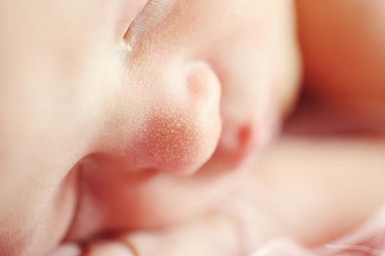 Mụn sữa ở trẻ sơ sinh đa phần có thể tự hết mà không cần điều trị