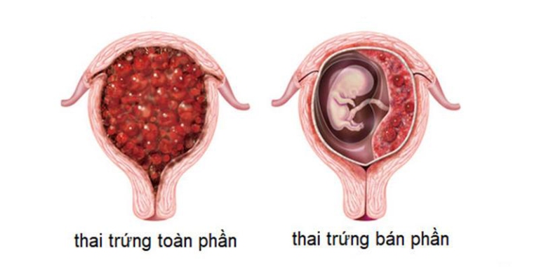 Hiện tượng rong kinh xuất hiện trong quá trình mang thai 
