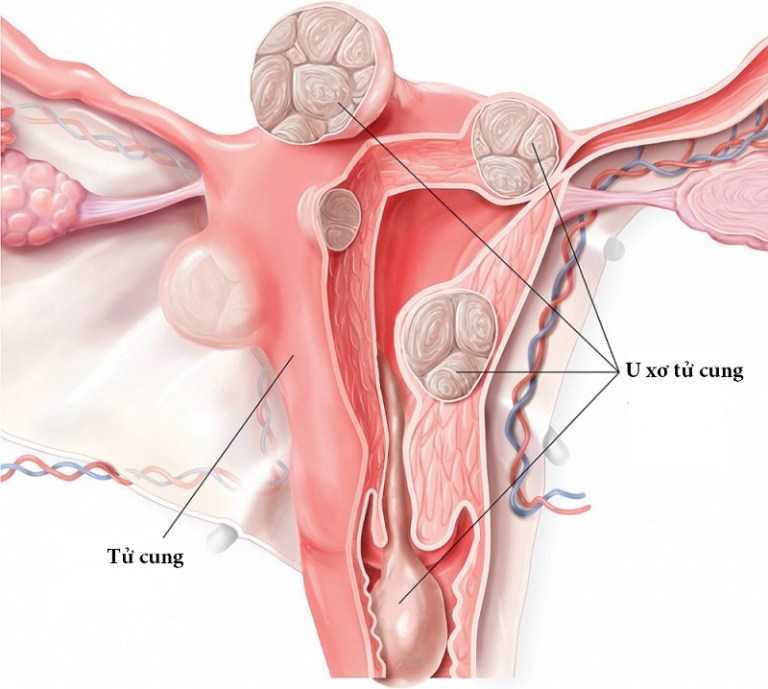 U xơ tử cung là những khối u lành tính phát triển bên trong tử cung