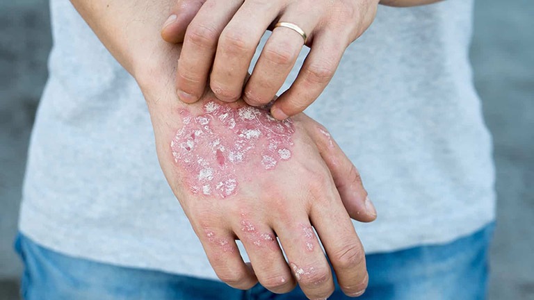 Người bệnh không nên cào gãi hoặc chà xát mạnh vào vùng da bị tổn thương