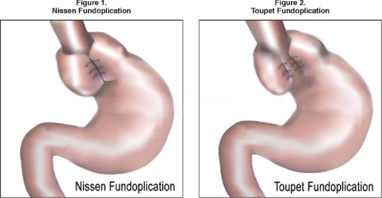 Khác biệt giữa phẫu thuật Nissen và phẫu thuật Toupet