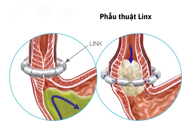 Phẫu thuật tăng cường cơ vòng thực quản dưới Linx