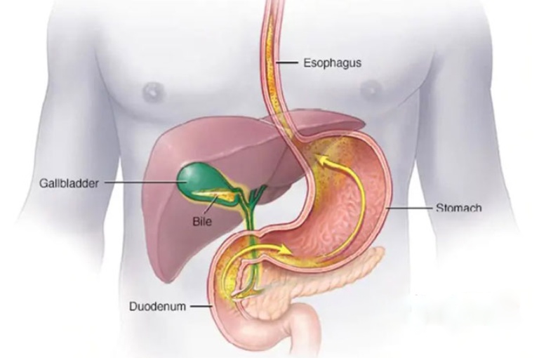 Viêm hang vị dạ dày trào ngược dịch mật là tình trạng dịch mật trào ngược từ tá tràng lên dạ dày - thực quản