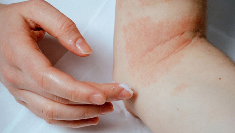 Người bệnh cần bôi kem dưỡng ẩm da thường xuyên để tránh bong tróc da