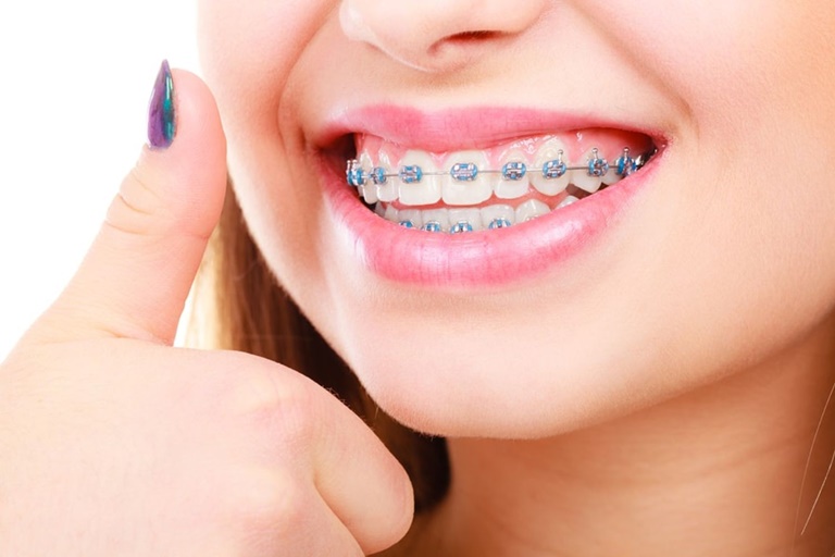 Dây cung niềng răng giúp điều chỉnh các răng xô lệch về đúng vị trí chuẩn trên hàm