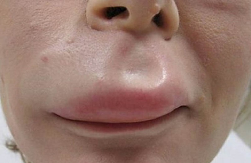 Nổi mề đay sưng môi là một dạng bệnh mề đay phù mạch phổ biến