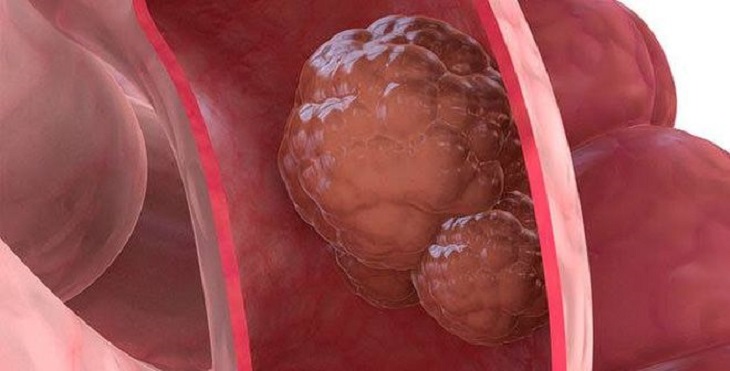 Polyp đại tràng sigma có thể biến chuyển thành ung thư