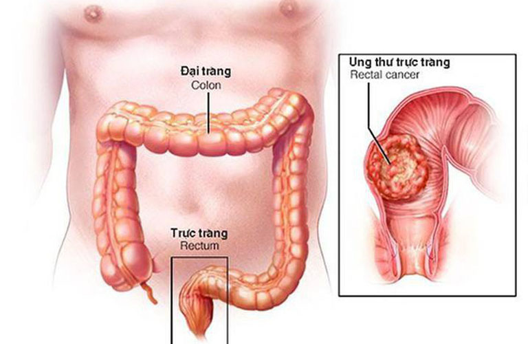 ung thu dai trang co chua duoc khong