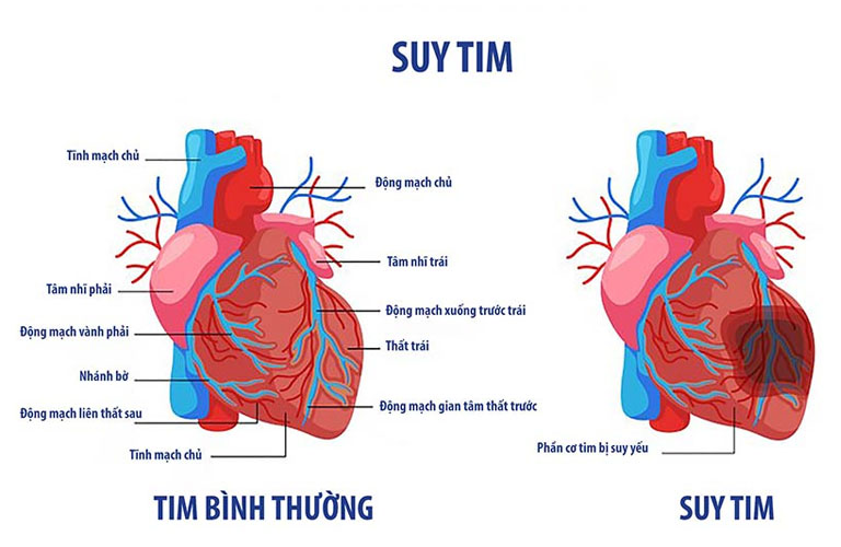 benh suy tim co chua duoc khong