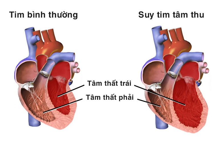 benh suy tim co chua duoc khong